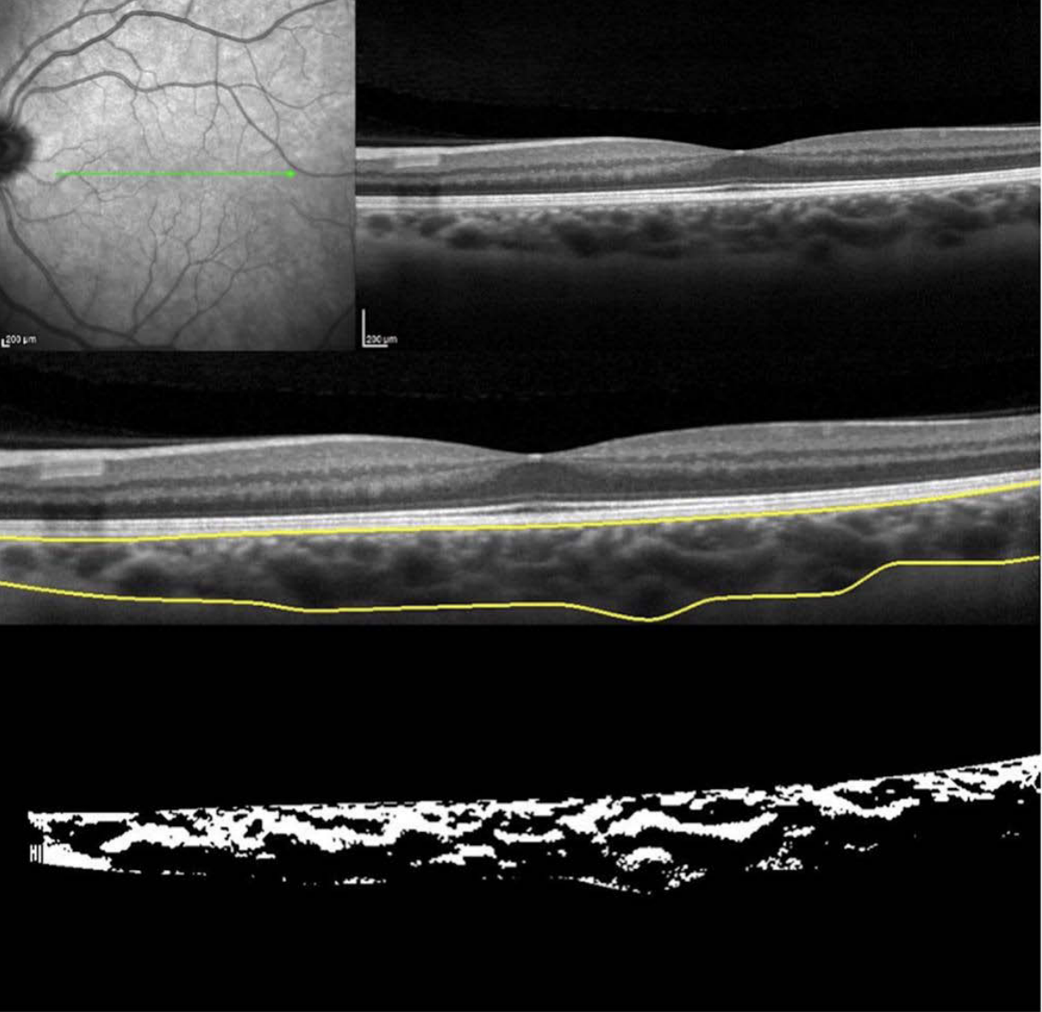 A review of 41 studies highlighted an association between greater early choroidal thickening and reduced axial elongation at one year in patients being treated for myopia. Among the interventions studied, choroidal responses were most pronounced in patients receiving repeated low-level red-light therapy.